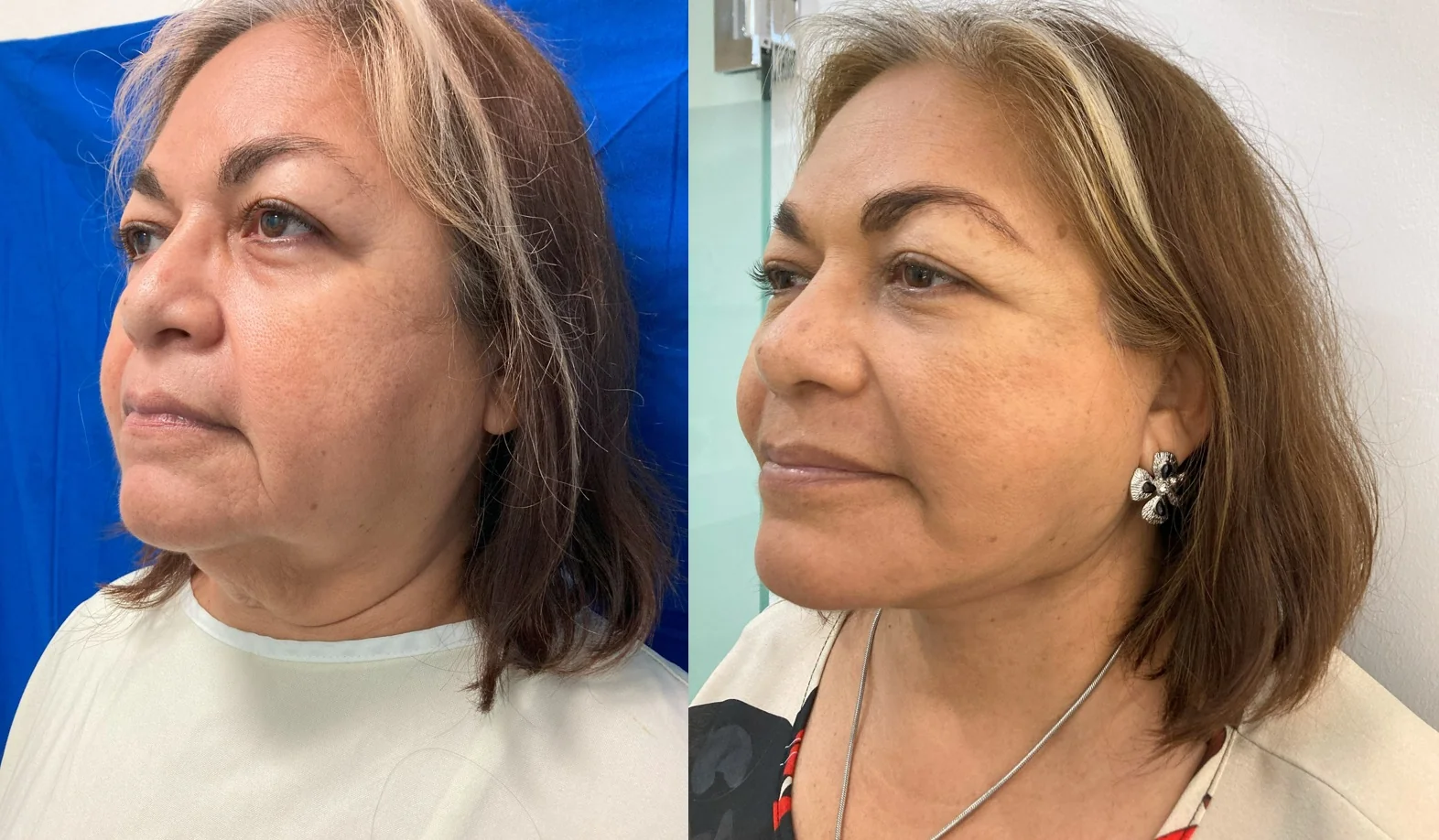 Resultados antes y despues de lifting facial y de cuello en Mérida.