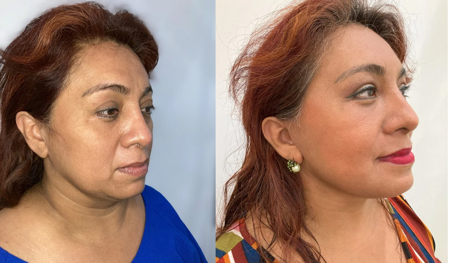 Comparativa de rejuvenecimiento facial quirúrgico en Mérida.