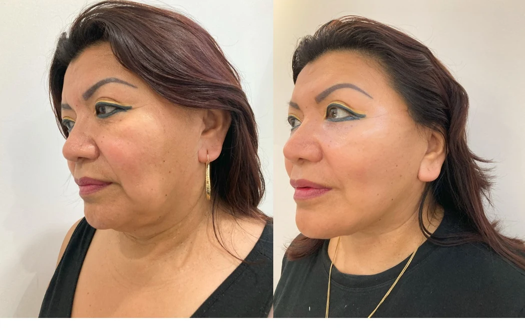 Resultado clínico real: Antes y después de lifting facial y de cuello por el Dr. Tomás Pacheco.