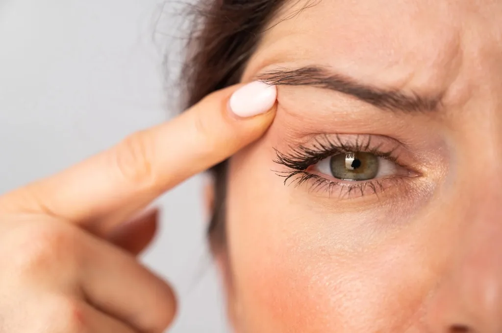 Resultados estéticos de una mirada descansada y natural tras una cirugía de lifting de cejas.