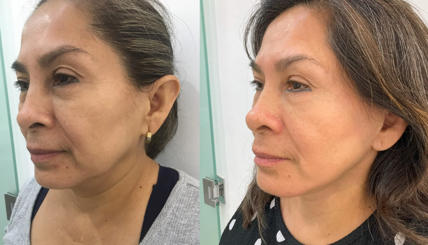 Resultado de Lifting Facial de Planos Profundos Mavenn.mx Mérida.
