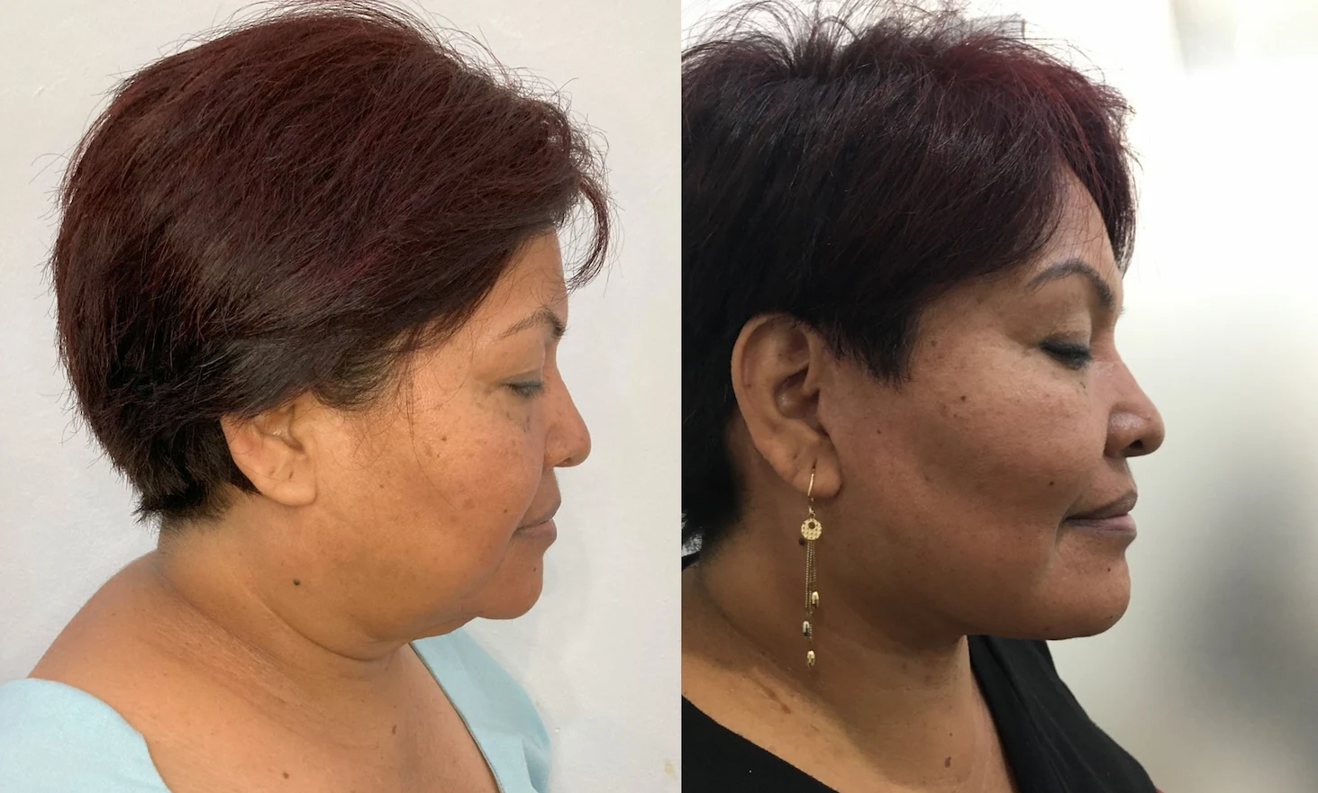 Resultados naturales de lifting facial profundo por el Dr. Tomás Pacheco.