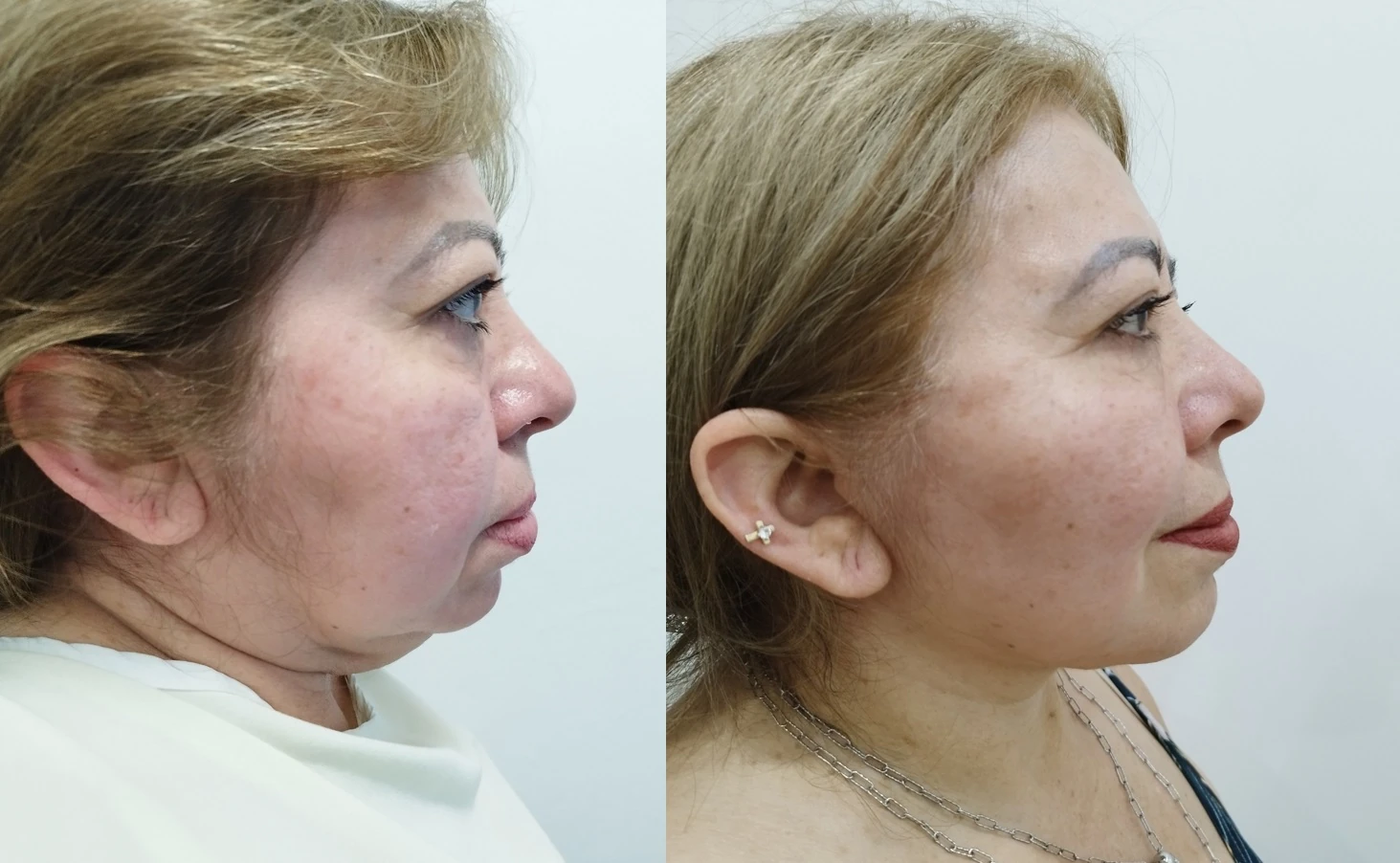 Resultados de Lifting facial y Lifting de cuello en Mérida.